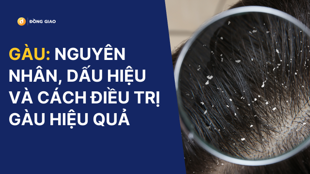 Gàu: Nguyên Nhân, Dấu Hiệu và Cách Điều Trị Gàu Hiệu Quả