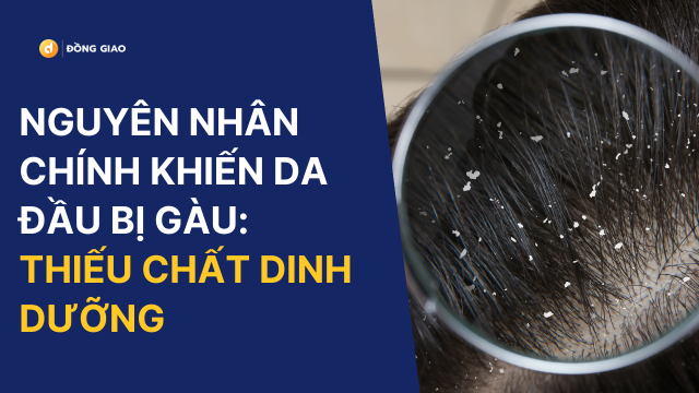 Nguyên nhân chính khiến da đầu bị gàu